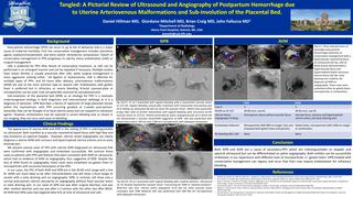 Tangled: A Pictorial Review of Ultrasound and Angiography of Postpartum Hemorrhage due to Uterine Arteriovenous Malformations and Sub-Involution of the Placental Bed