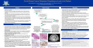 Occult Breast Cancer Metastasis Presenting as Acute Liver Failure