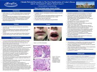 Chronic Peri-Oral Dermatitis as the First Manifestations of Crohn's Disease