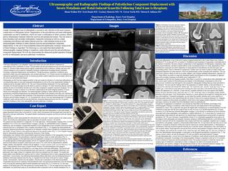 Ultrasonographic and Radiographic Findings of Polyethylene Component Displacement with Severe Metallosis and Metal-Induced Synovitis Following Total Knee Arthroplasty