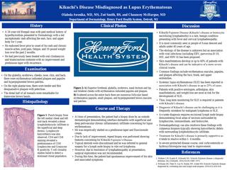 Kikuchi's Disease presenting as Lupus Erythematosus