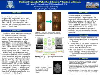 Bilateral Segmental Optic Disc Edema in Vitamin B1 Deficiency