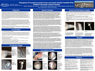 Management of Traumatic Coracoid Fracture and Anterior Shoulder Instability With a Modified Arthroscopic Latarjet Technique
