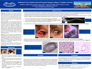 Inflamed Non-Limbal Scleral Dermoid Masquerading as Nodular Scleritis