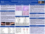 A Rare and Newly Recognized Kaposi Sarcoma Herpes Virus-Associated Disease by Faria Ali, Qunfang Li, Akhil Rahman, Vivek Kak, Michael Somero, Chidamber Alamelumangapuram, and Richard Santos