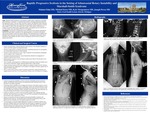 Rapidly progressive scoliosis in a patient with Marshall-Smith Syndrome