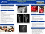 Brachial Artery Pseudoaneurysm Secondary to a Sessile Osteochondroma in an Avid Teenage Basketball Player