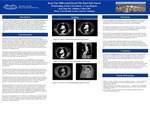 Keep Your Differential Broad This Back Pain Season Penetrating Aortic Ulceration: A Case Report