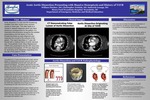 Acute Aortic Dissection Presenting with Massive Hemoptysis and History of TAVR