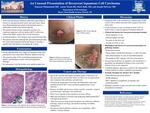 An Unusual Presentation of Recurrent Squamous Cell Carcinoma