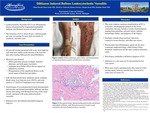 Diltiazem Induced Bullous Leukocytoclastic Vasculitis