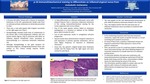 p-16: immunohistochemical staining to differentiate an inflamed atypical nevus by Madeline Adelman, Alexis B. Lyons, Lauren Seale, and Ben J. Friedman
