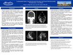 Bi-atrial thrombus causing embolic stroke and pulmonary embolisms by Hisham Alhajala, Iyad Isseh, and Daniel J. Miller
