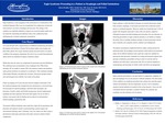 Eagle Syndrome Presenting in a Patient as Dysphagia and Failed Intubations by Alison Bradley, Natalie Stec, and Sean Drake